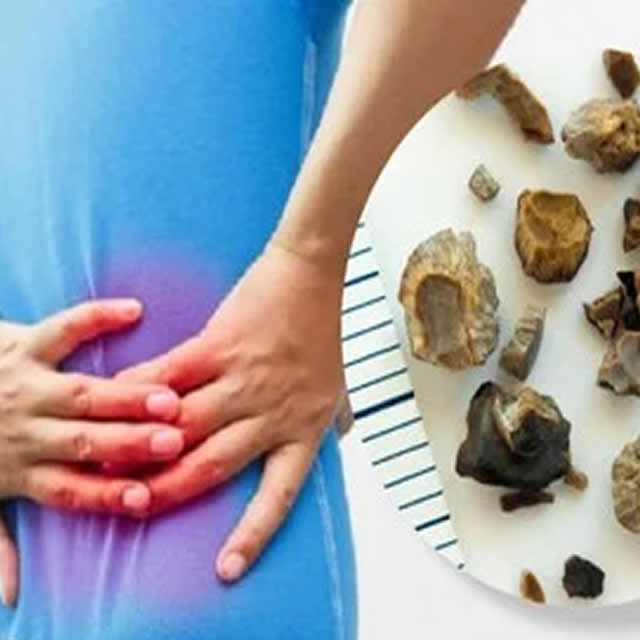 cálculos renales quito